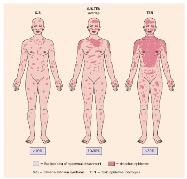 Pictural representation of SJS, SJS-TEN overlap and TEN showing the... | Download Scientific Diagram